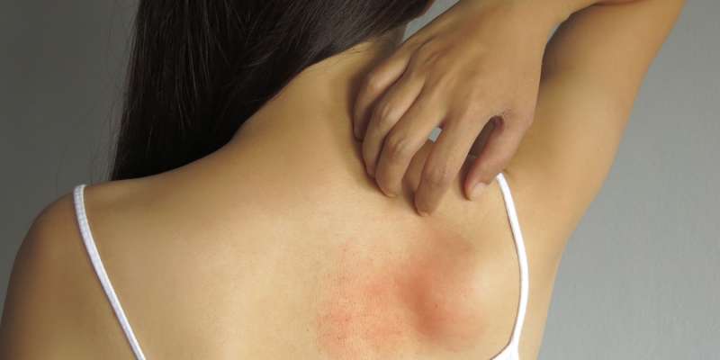 Pemfigus Hastalığı Nedir? Belirtileri Nelerdir?